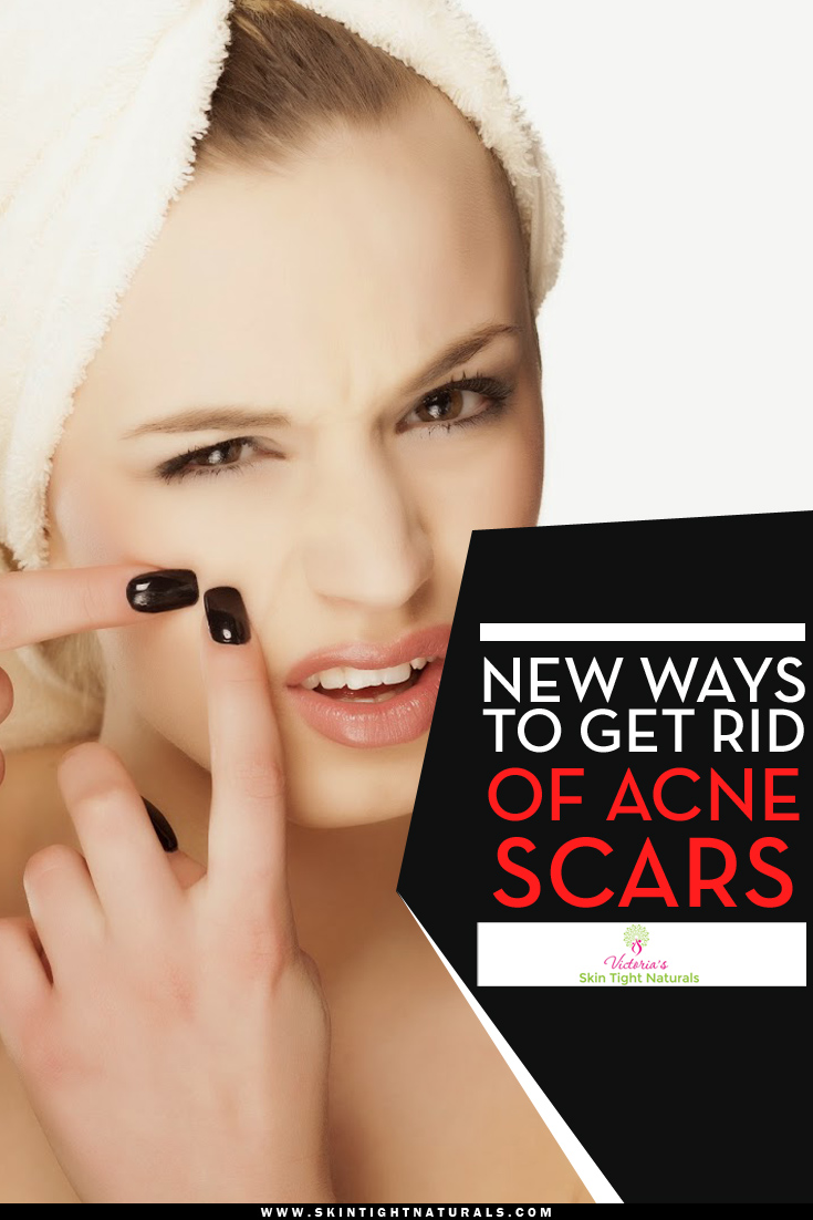 <b>New Ways</b> To Get Rid of Acne Scars - New-Ways-To-Get-Rid-of-Acne-Scars