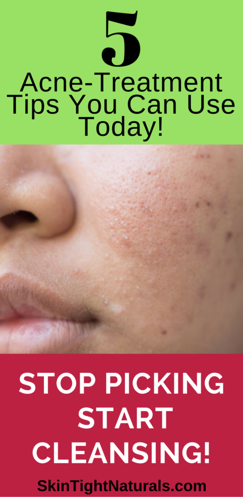 Acne Treatment Tips