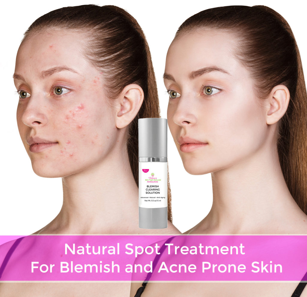Blemish Clearing Solution