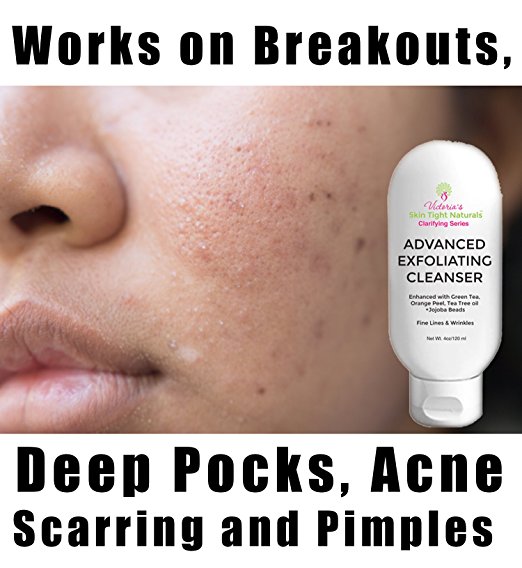 Help! How To Treat Hormonal Acne & Stop Breakouts!