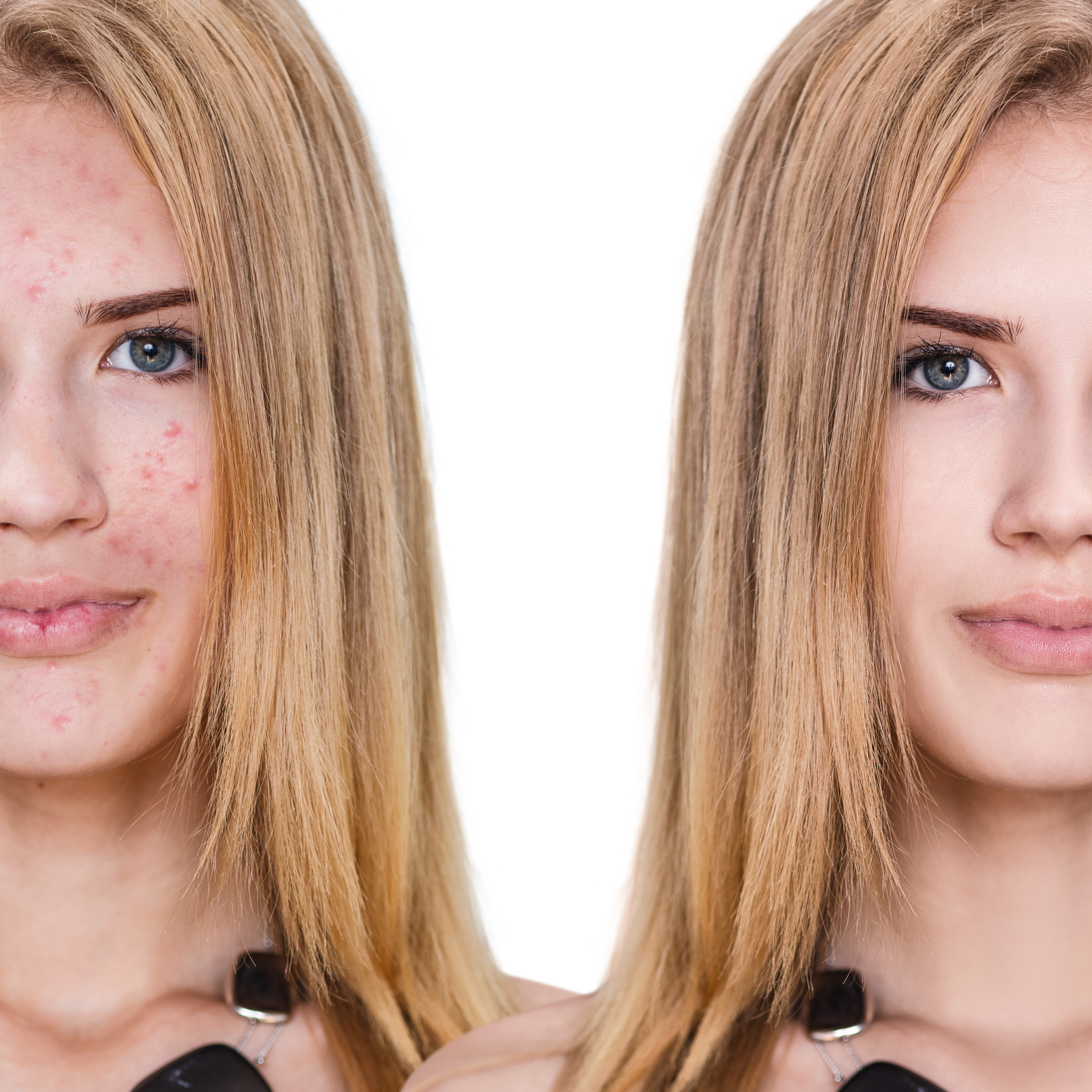 Cystic Acne: How To Get Rid Of It