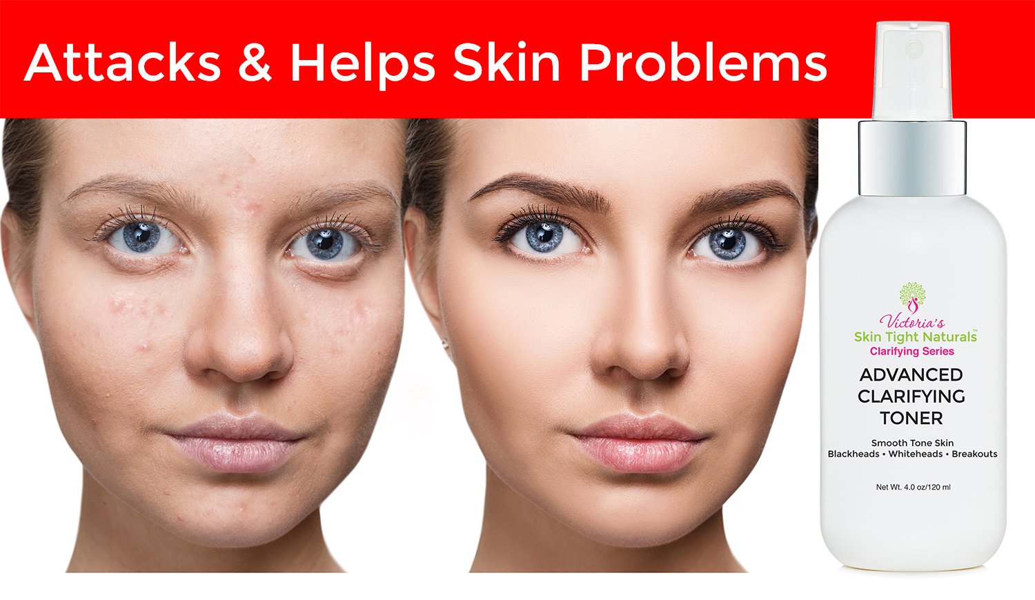 Taking Care Of Acne-Prone Skin
