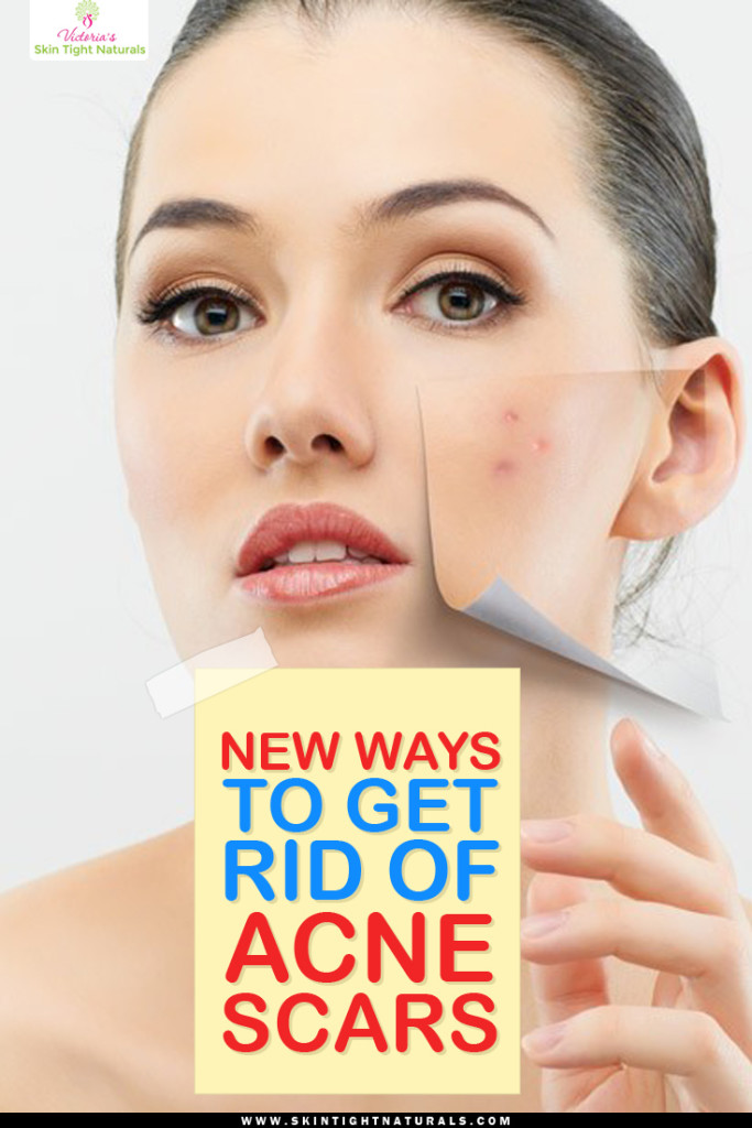 Get Rid of Acne Scars