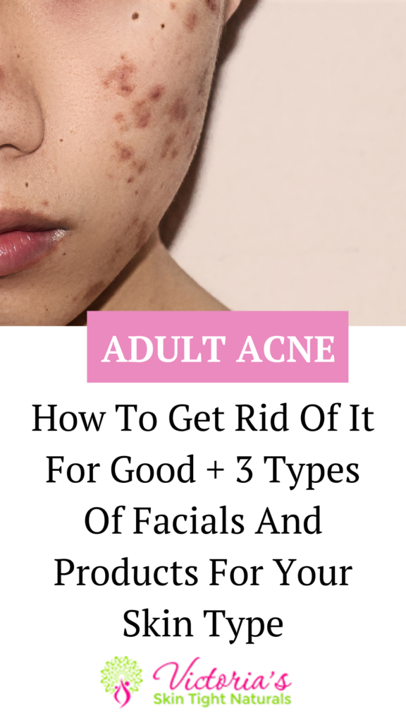 3 Best Facials for Fighting Acne & Pesky Pimples - Skin Tight Naturals