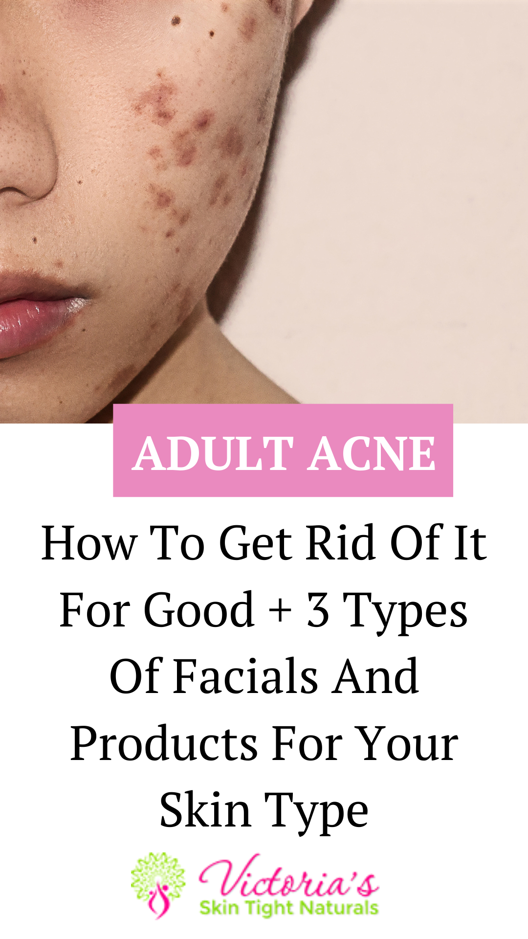 3 Best Facials for Fighting Acne & Pesky Pimples
