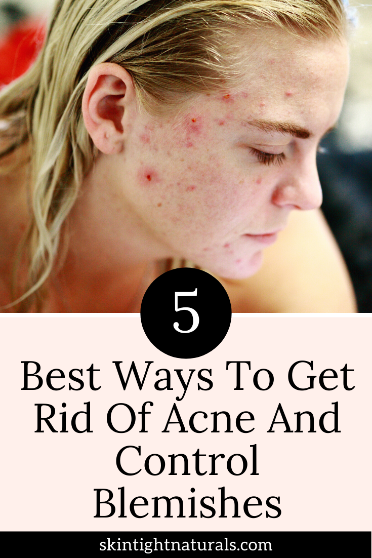 5 Acne Treatment Tips You Can Use Today!