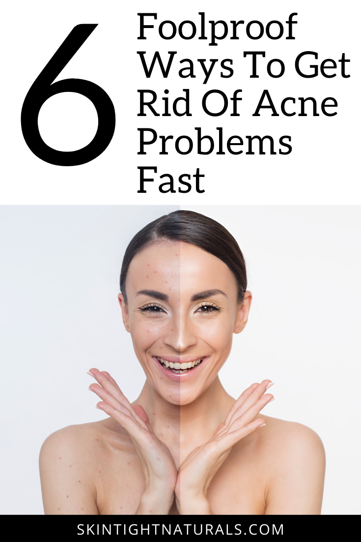 How to Reverse Acne Problems Fast!