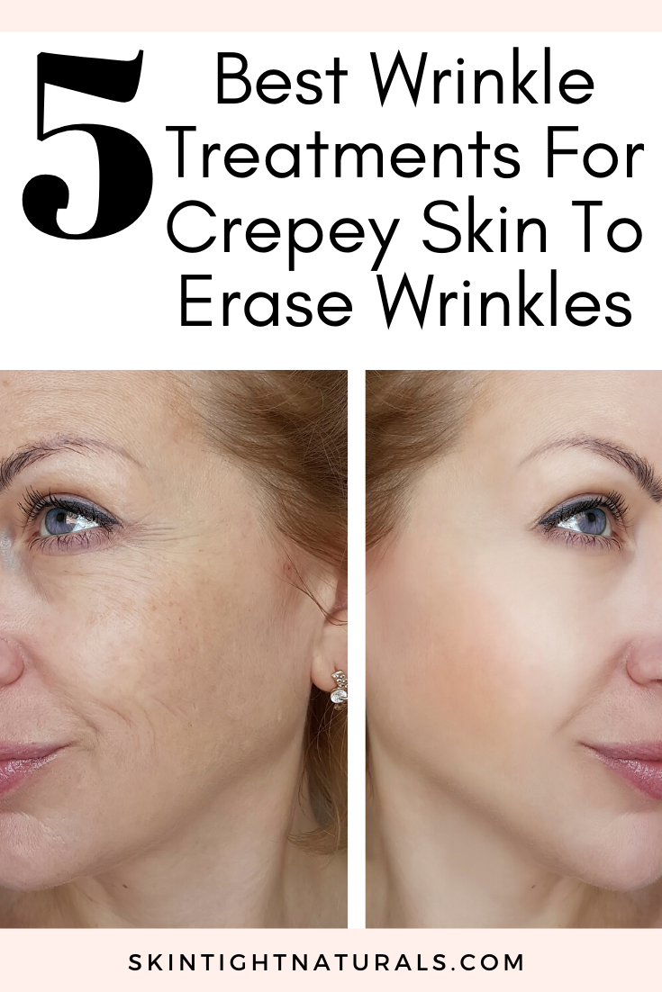 Best Wrinkle Treatments For Crepey Skin 