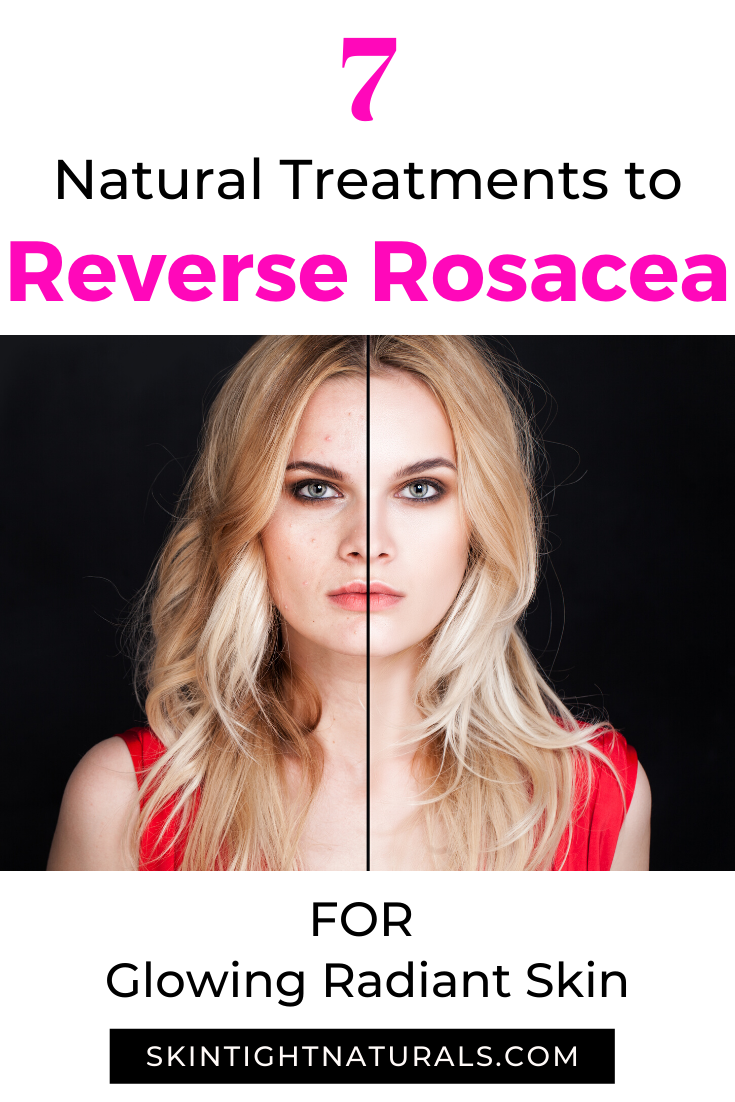 How To Get Rid of Rosacea