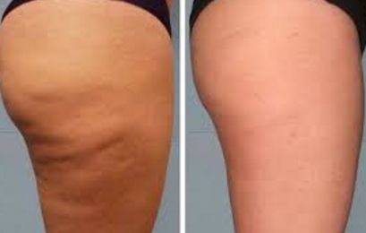 Best Anti-Cellulite Body Wrap Tips For Smooth Tight Legs And Abs