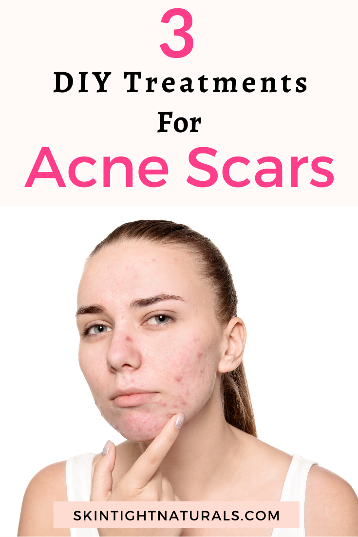 Fix Your Acne Scars Now!