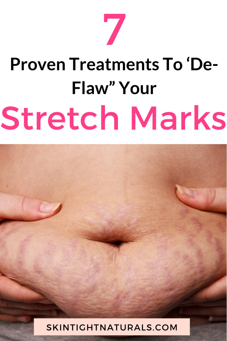 HELP! I Have Stretch Marks!