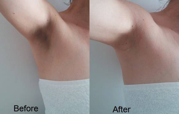 How To Lighten Armpits Fast!
