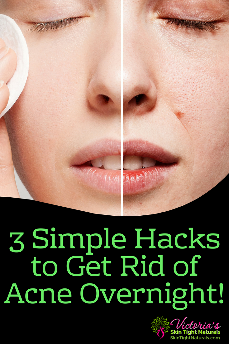 How To Get Rid Of Acne Overnight