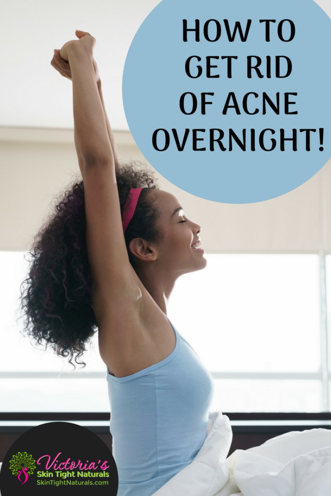 How To Get Rid Of Acne Overnight - Skin Tight Naturals