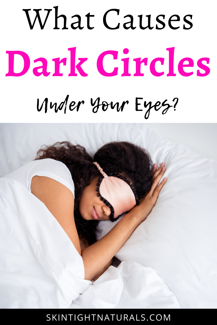 Why Do I Have Dark Circles Under My Eyes?