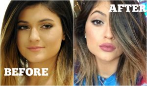 kylie-jenner-before-after