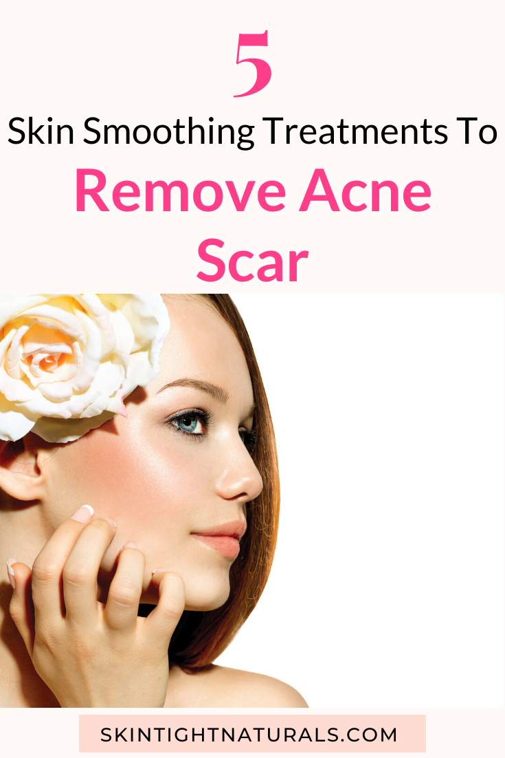 Best Acne Scar Removal For Teens