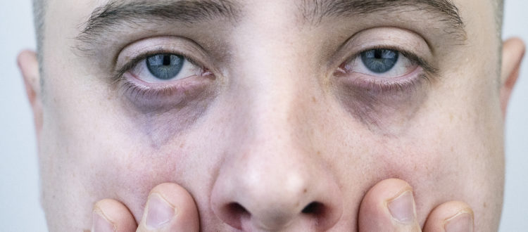 5 Ways Men Can Get Rid Of Dark Circles Under Their Eyes