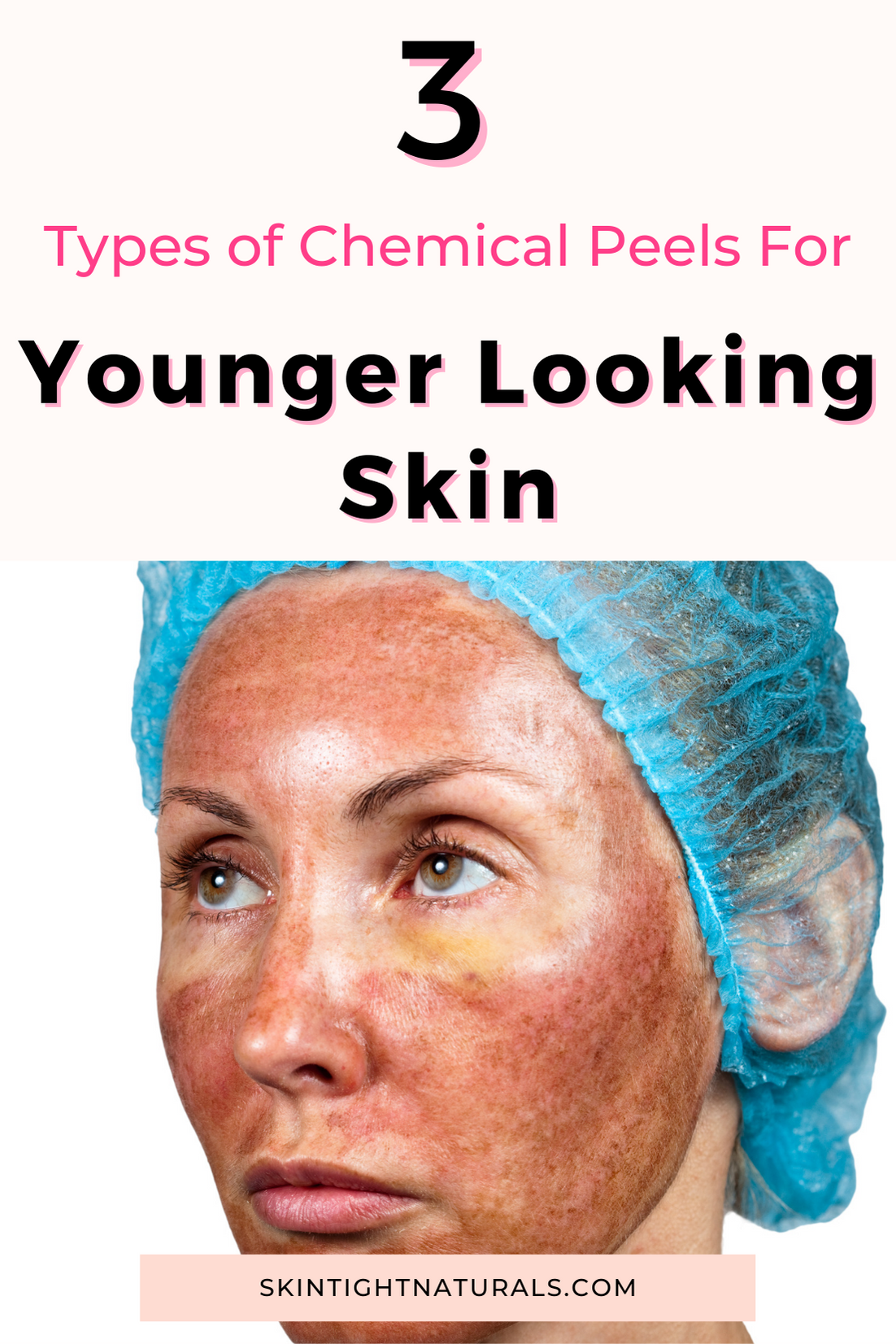 3 Types of Chemical Peels for Younger Looking Skin