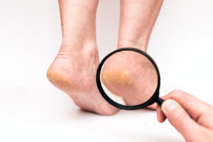 Natural Solutions For Cracked Heels