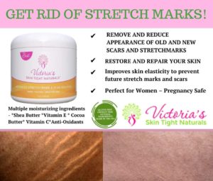 Best Stretch Mark Removal Treatments