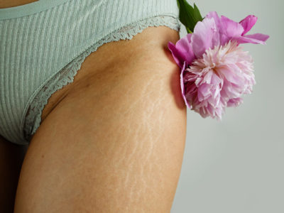 Best Stretch Mark Removal Treatments