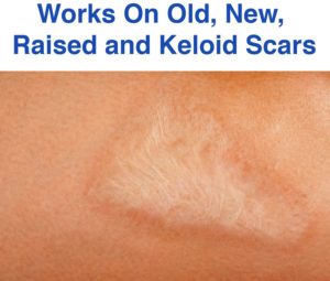 How To Fade Scars Naturally