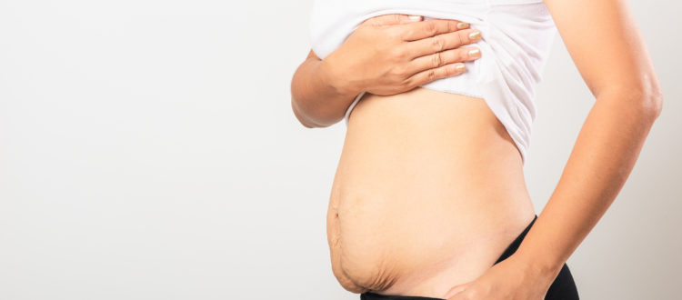 How To Finally Tighten Your Loose Belly Skin