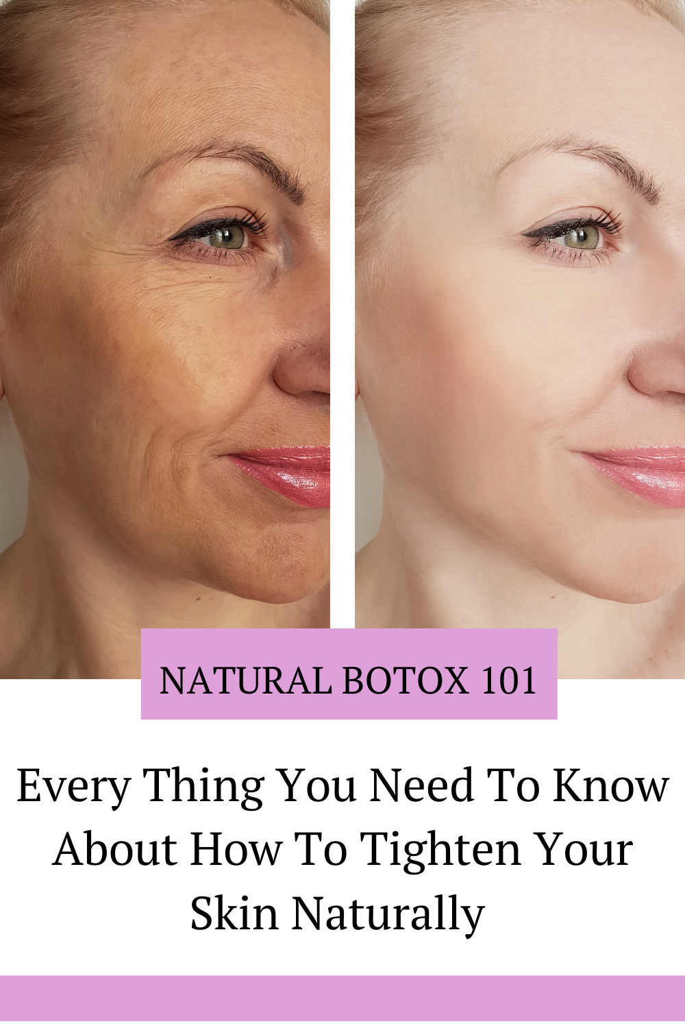 Botox Without The Needle