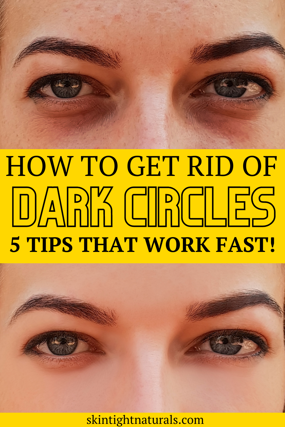 How To Get Rid Of Dark Under-Eye Circles